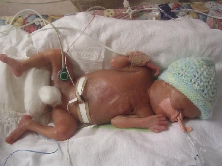 Harrison in NICU